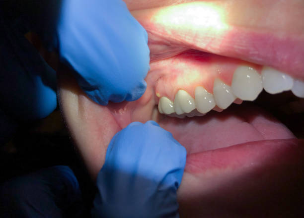 Best Emergency Dental Care for Broken or Chipped Teeth in Flippin, AR
